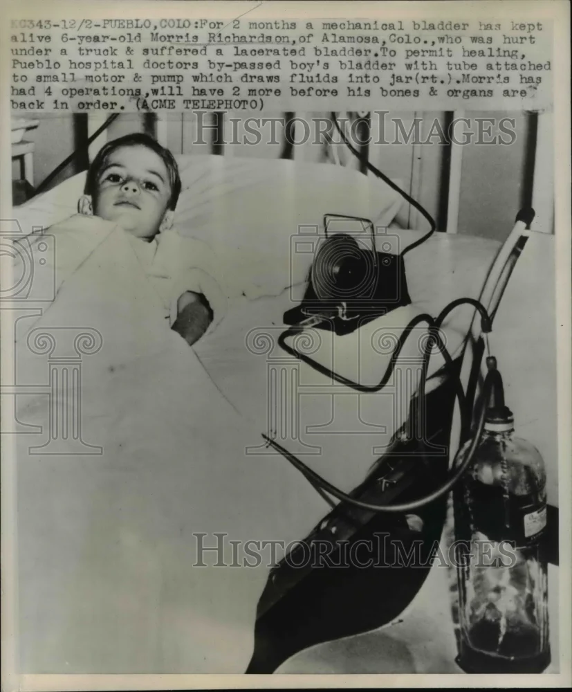 1947 Press Photo Morris Richardson Using Mechanical Bladder for 6 Months